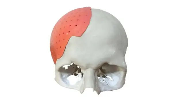 Kafatası Ameliyatları